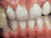 Как отбелить зубы перекисью водорода?