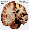 Как проявляется болезнь Альцгеймера и что это за недуг?