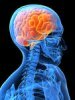 Каковы симптомы нарушения мозгового кровообращения?