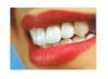 Что такое зубной камень и как с ним бороться?