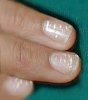Откуда берутся белые пятна на ногтях?