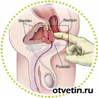 Можно ли полностью вылечиться от простатита?